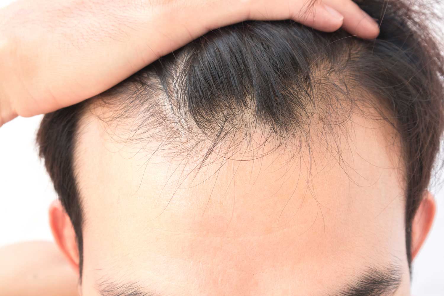 Pattern Of Hair fall